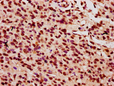 HIST1H2AI Antibody - Immunohistochemistry Dilution at 1:10 and staining in paraffin-embedded human glioma cancer performed on a Leica BondTM system. After dewaxing and hydration, antigen retrieval was mediated by high pressure in a citrate buffer (pH 6.0). Section was blocked with 10% normal Goat serum 30min at RT. Then primary antibody (1% BSA) was incubated at 4°C overnight. The primary is detected by a biotinylated Secondary antibody and visualized using an HRP conjugated SP system.