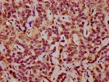 HIST1H2AI Antibody - Immunohistochemistry Dilution at 1:10 and staining in paraffin-embedded human liver cancer performed on a Leica BondTM system. After dewaxing and hydration, antigen retrieval was mediated by high pressure in a citrate buffer (pH 6.0). Section was blocked with 10% normal Goat serum 30min at RT. Then primary antibody (1% BSA) was incubated at 4°C overnight. The primary is detected by a biotinylated Secondary antibody and visualized using an HRP conjugated SP system.