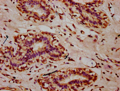 HIST1H2AI Antibody - Immunohistochemistry Dilution at 1:10 and staining in paraffin-embedded human breast cancer performed on a Leica BondTM system. After dewaxing and hydration, antigen retrieval was mediated by high pressure in a citrate buffer (pH 6.0). Section was blocked with 10% normal Goat serum 30min at RT. Then primary antibody (1% BSA) was incubated at 4°C overnight. The primary is detected by a biotinylated Secondary antibody and visualized using an HRP conjugated SP system.