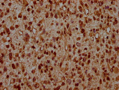 HIST1H2AI Antibody - Immunohistochemistry Dilution at 1:20 and staining in paraffin-embedded human glioma cancer performed on a Leica BondTM system. After dewaxing and hydration, antigen retrieval was mediated by high pressure in a citrate buffer (pH 6.0). Section was blocked with 10% normal Goat serum 30min at RT. Then primary antibody (1% BSA) was incubated at 4°C overnight. The primary is detected by a biotinylated Secondary antibody and visualized using an HRP conjugated SP system.