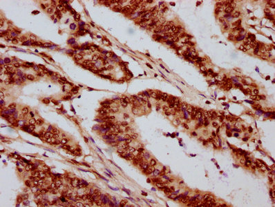 HIST1H2AI Antibody - Immunohistochemistry Dilution at 1:20 and staining in paraffin-embedded human colon cancer performed on a Leica BondTM system. After dewaxing and hydration, antigen retrieval was mediated by high pressure in a citrate buffer (pH 6.0). Section was blocked with 10% normal Goat serum 30min at RT. Then primary antibody (1% BSA) was incubated at 4°C overnight. The primary is detected by a biotinylated Secondary antibody and visualized using an HRP conjugated SP system.