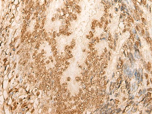 HIST1H2BA Antibody - Immunohistochemistry of paraffin-embedded Human colorectal cancer tissue  using HIST1H2BA Polyclonal Antibody at dilution of 1:45(×200)