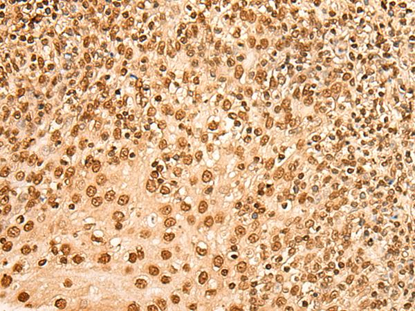 HIST1H2BA Antibody - Immunohistochemistry of paraffin-embedded Human tonsil tissue  using HIST1H2BA Polyclonal Antibody at dilution of 1:45(×200)
