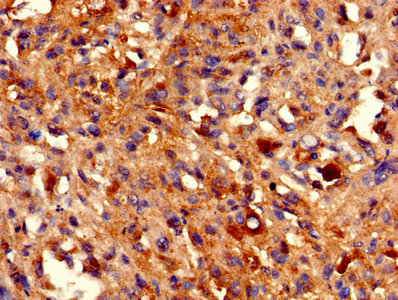 HIST1H2BB Antibody - IHC image of HIST1H2BB Antibody diluted at 1:800 and staining in paraffin-embedded human melanoma performed on a Leica BondTM system. After dewaxing and hydration, antigen retrieval was mediated by high pressure in a citrate buffer (pH 6.0). Section was blocked with 10% normal goat serum 30min at RT. Then primary antibody (1% BSA) was incubated at 4°C overnight. The primary is detected by a biotinylated secondary antibody and visualized using an HRP conjugated SP system.