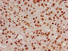 HIST1H2BB Antibody - Immunohistochemistry image of paraffin-embedded human glioma cancer at a dilution of 1:100
