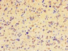HIST1H2BD Antibody - Immunohistochemistry of paraffin-embedded human glioma cancer at dilution 1:100
