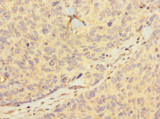 HIST1H2BD Antibody - Paraffin-embedding Immunohistochemistry using human ovarian cancer at dilution 1:100