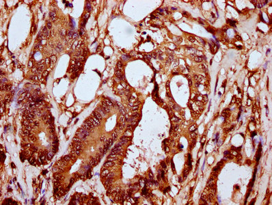 HIST1H2BN Antibody - Immunohistochemistry Dilution at 1:10 and staining in paraffin-embedded human colon cancer performed on a Leica BondTM system. After dewaxing and hydration, antigen retrieval was mediated by high pressure in a citrate buffer (pH 6.0). Section was blocked with 10% normal Goat serum 30min at RT. Then primary antibody (1% BSA) was incubated at 4°C overnight. The primary is detected by a biotinylated Secondary antibody and visualized using an HRP conjugated SP system.