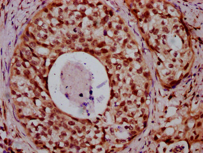 HIST1H2BN Antibody - Immunohistochemistry Dilution at 1:20 and staining in paraffin-embedded human cervical cancer performed on a Leica BondTM system. After dewaxing and hydration, antigen retrieval was mediated by high pressure in a citrate buffer (pH 6.0). Section was blocked with 10% normal Goat serum 30min at RT. Then primary antibody (1% BSA) was incubated at 4°C overnight. The primary is detected by a biotinylated Secondary antibody and visualized using an HRP conjugated SP system.