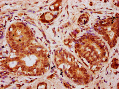 HIST1H2BN Antibody - Immunohistochemistry Dilution at 1:10 and staining in paraffin-embedded human breast cancer performed on a Leica BondTM system. After dewaxing and hydration, antigen retrieval was mediated by high pressure in a citrate buffer (pH 6.0). Section was blocked with 10% normal Goat serum 30min at RT. Then primary antibody (1% BSA) was incubated at 4°C overnight. The primary is detected by a biotinylated Secondary antibody and visualized using an HRP conjugated SP system.