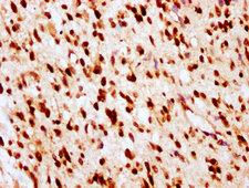 HIST1H2BN Antibody - Immunohistochemistry Dilution at 1:10 and staining in paraffin-embedded human glioma cancer performed on a Leica BondTM system. After dewaxing and hydration, antigen retrieval was mediated by high pressure in a citrate buffer (pH 6.0). Section was blocked with 10% normal Goat serum 30min at RT. Then primary antibody (1% BSA) was incubated at 4°C overnight. The primary is detected by a biotinylated Secondary antibody and visualized using an HRP conjugated SP system.