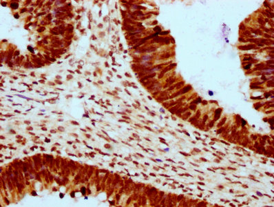 HIST1H2BN Antibody - Immunohistochemistry Dilution at 1:10 and staining in paraffin-embedded human ovarian cancer performed on a Leica BondTM system. After dewaxing and hydration, antigen retrieval was mediated by high pressure in a citrate buffer (pH 6.0). Section was blocked with 10% normal Goat serum 30min at RT. Then primary antibody (1% BSA) was incubated at 4°C overnight. The primary is detected by a biotinylated Secondary antibody and visualized using an HRP conjugated SP system.