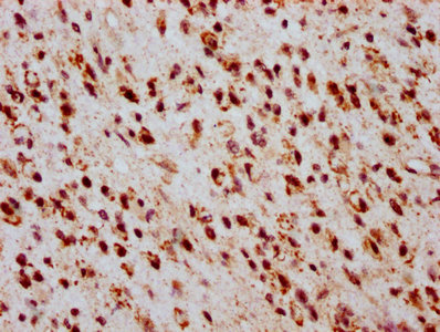 HIST1H2BN Antibody - Immunohistochemistry Dilution at 1:20 and staining in paraffin-embedded human glioma cancer performed on a Leica BondTM system. After dewaxing and hydration, antigen retrieval was mediated by high pressure in a citrate buffer (pH 6.0). Section was blocked with 10% normal Goat serum 30min at RT. Then primary antibody (1% BSA) was incubated at 4°C overnight. The primary is detected by a biotinylated Secondary antibody and visualized using an HRP conjugated SP system.