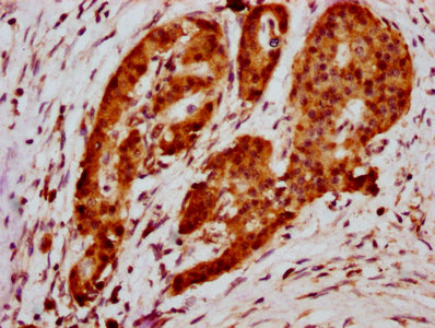 HIST1H2BN Antibody - Immunohistochemistry Dilution at 1:20 and staining in paraffin-embedded human pancreatic cancer performed on a Leica BondTM system. After dewaxing and hydration, antigen retrieval was mediated by high pressure in a citrate buffer (pH 6.0). Section was blocked with 10% normal Goat serum 30min at RT. Then primary antibody (1% BSA) was incubated at 4°C overnight. The primary is detected by a biotinylated Secondary antibody and visualized using an HRP conjugated SP system.