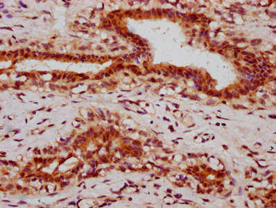 HIST1H2BN Antibody - Immunohistochemistry Dilution at 1:10 and staining in paraffin-embedded human breast cancer performed on a Leica BondTM system. After dewaxing and hydration, antigen retrieval was mediated by high pressure in a citrate buffer (pH 6.0). Section was blocked with 10% normal Goat serum 30min at RT. Then primary antibody (1% BSA) was incubated at 4°C overnight. The primary is detected by a biotinylated Secondary antibody and visualized using an HRP conjugated SP system.