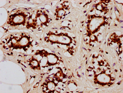 HIST1H2BN Antibody - Immunohistochemistry Dilution at 1:20 and staining in paraffin-embedded human breast cancer performed on a Leica BondTM system. After dewaxing and hydration, antigen retrieval was mediated by high pressure in a citrate buffer (pH 6.0). Section was blocked with 10% normal Goat serum 30min at RT. Then primary antibody (1% BSA) was incubated at 4°C overnight. The primary is detected by a biotinylated Secondary antibody and visualized using an HRP conjugated SP system.