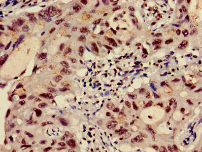 HIST1H3A Antibody - Immunohistochemistry image of paraffin-embedded human lung cancer at a dilution of 1:100