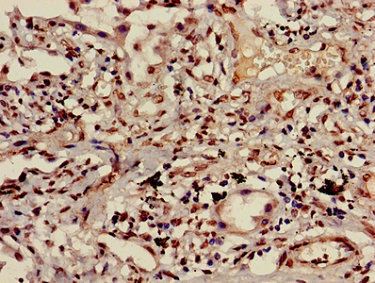 HIST1H3A Antibody - Immunohistochemistry image of paraffin-embedded human lung cancer at a dilution of 1:100