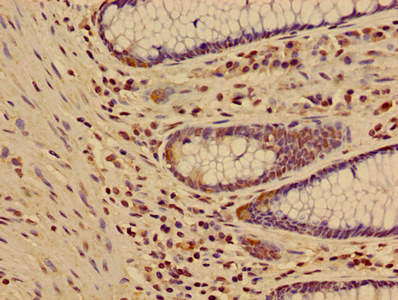 HIST1H3A Antibody - Immunohistochemistry image of paraffin-embedded human colon cancer at a dilution of 1:100