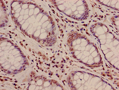 HIST1H3A Antibody - Immunohistochemistry image of paraffin-embedded human colon cancer at a dilution of 1:100