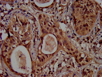 HIST1H3A Antibody - Immunohistochemistry image at a dilution of 1:100 and staining in paraffin-embedded human cervical cancer performed on a Leica BondTM system. After dewaxing and hydration, antigen retrieval was mediated by high pressure in a citrate buffer (pH 6.0) . Section was blocked with 10% normal goat serum 30min at RT. Then primary antibody (1% BSA) was incubated at 4 °C overnight. The primary is detected by a biotinylated secondary antibody and visualized using an HRP conjugated SP system.