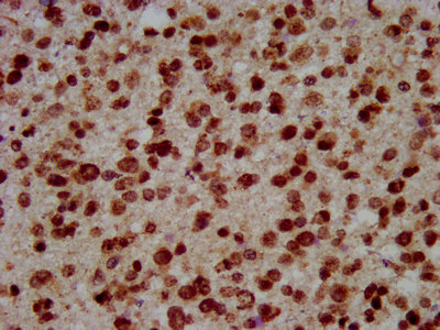HIST1H3A Antibody - Immunohistochemistry staining in paraffin-embedded human glioma cancer performed on a Leica BondTM system. After dewaxing and hydration, antigen retrieval was mediated by high pressure in a citrate buffer (pH 6.0) . Section was blocked with 10% normal goat serum 30min at RT. Then primary antibody (1% BSA) was incubated at 4 °C overnight. The primary is detected by a biotinylated secondary antibody and visualized using an HRP conjugated SP system.
