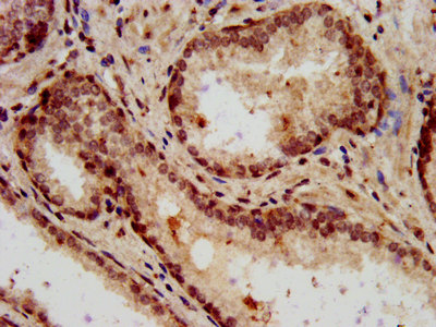 HIST1H3A Antibody - Immunohistochemistry staining in paraffin-embedded human prostate cancer performed on a Leica BondTM system. After dewaxing and hydration, antigen retrieval was mediated by high pressure in a citrate buffer (pH 6.0) . Section was blocked with 10% normal goat serum 30min at RT. Then primary antibody (1% BSA) was incubated at 4 °C overnight. The primary is detected by a biotinylated secondary antibody and visualized using an HRP conjugated SP system.