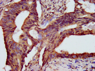 HIST1H3A Antibody - Immunohistochemistry image at a dilution of 1: 10 and staining in paraffin-embedded human colon cancer performed on a Leica BondTM system. After dewaxing and hydration, antigen retrieval was mediated by high pressure in a citrate buffer (pH 6.0) . Section was blocked with 10% normal goat serum 30min at RT. Then primary antibody (1% BSA) was incubated at 4 °C overnight. The primary is detected by a biotinylated secondary antibody and visualized using an HRP conjugated SP system.