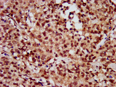 HIST1H3A Antibody - Immunohistochemistry image at a dilution of 1: 10 and staining in paraffin-embedded human ovarian cancer performed on a Leica BondTM system. After dewaxing and hydration, antigen retrieval was mediated by high pressure in a citrate buffer (pH 6.0) . Section was blocked with 10% normal goat serum 30min at RT. Then primary antibody (1% BSA) was incubated at 4 °C overnight. The primary is detected by a biotinylated secondary antibody and visualized using an HRP conjugated SP system.