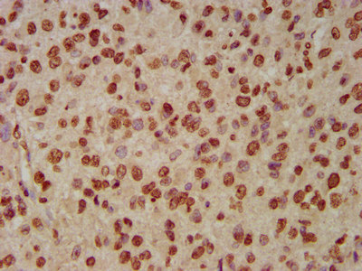 HIST1H3A Antibody - Immunohistochemistry image at a dilution of 1:50 and staining in paraffin-embedded human glioma cancer performed on a Leica BondTM system. After dewaxing and hydration, antigen retrieval was mediated by high pressure in a citrate buffer (pH 6.0) . Section was blocked with 10% normal goat serum 30min at RT. Then primary antibody (1% BSA) was incubated at 4 °C overnight. The primary is detected by a biotinylated secondary antibody and visualized using an HRP conjugated SP system.