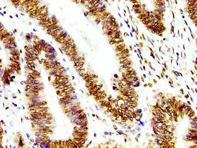 HIST1H3A Antibody - Immunohistochemistry Dilution at 1:100 and staining in paraffin-embedded human colon cancer performed on a Leica BondTM system. After dewaxing and hydration, antigen retrieval was mediated by high pressure in a citrate buffer (pH 6.0). Section was blocked with 10% normal Goat serum 30min at RT. Then primary antibody (1% BSA) was incubated at 4°C overnight. The primary is detected by a biotinylated Secondary antibody and visualized using an HRP conjugated SP system.