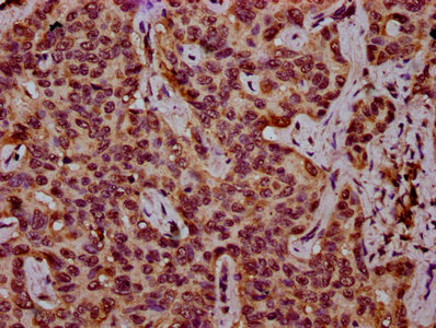 HIST1H3A Antibody - Immunohistochemistry Dilution at 1:10 and staining in paraffin-embedded human liver cancer performed on a Leica BondTM system. After dewaxing and hydration, antigen retrieval was mediated by high pressure in a citrate buffer (pH 6.0). Section was blocked with 10% normal Goat serum 30min at RT. Then primary antibody (1% BSA) was incubated at 4°C overnight. The primary is detected by a biotinylated Secondary antibody and visualized using an HRP conjugated SP system.