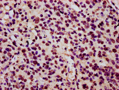 HIST1H3A Antibody - Immunohistochemistry Dilution at 1:15 and staining in paraffin-embedded human glioma cancer performed on a Leica BondTM system. After dewaxing and hydration, antigen retrieval was mediated by high pressure in a citrate buffer (pH 6.0). Section was blocked with 10% normal Goat serum 30min at RT. Then primary antibody (1% BSA) was incubated at 4°C overnight. The primary is detected by a biotinylated Secondary antibody and visualized using an HRP conjugated SP system.