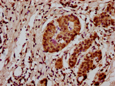 HIST1H3A Antibody - Immunohistochemistry Dilution at 1:20 and staining in paraffin-embedded human pancreatic cancer performed on a Leica BondTM system. After dewaxing and hydration, antigen retrieval was mediated by high pressure in a citrate buffer (pH 6.0). Section was blocked with 10% normal Goat serum 30min at RT. Then primary antibody (1% BSA) was incubated at 4°C overnight. The primary is detected by a biotinylated Secondary antibody and visualized using an HRP conjugated SP system.