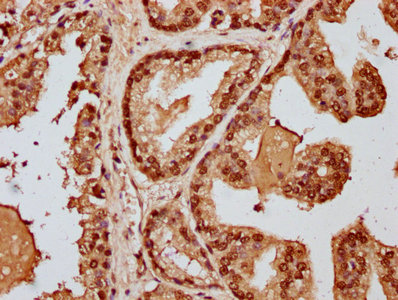 HIST1H3A Antibody - Immunohistochemistry Dilution at 1:20 and staining in paraffin-embedded human prostate cancer performed on a Leica BondTM system. After dewaxing and hydration, antigen retrieval was mediated by high pressure in a citrate buffer (pH 6.0). Section was blocked with 10% normal Goat serum 30min at RT. Then primary antibody (1% BSA) was incubated at 4°C overnight. The primary is detected by a biotinylated Secondary antibody and visualized using an HRP conjugated SP system.