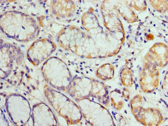 HIST1H3A Antibody - Immunohistochemistry of paraffin-embedded human gastric cancer at dilution 1:100