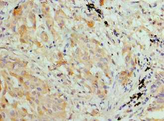HIST1H3A Antibody - Paraffin-embedding Immunohistochemistry using human lung cancer at dilution 1:100