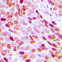 HIST1H3A Antibody - Immunohistochemical analysis of Histone H3 staining in human breast cancer formalin fixed paraffin embedded tissue section. The section was pre-treated using heat mediated antigen retrieval with sodium citrate buffer (pH 6.0). The section was then incubated with the antibody at room temperature and detected using an HRP conjugated compact polymer system. DAB was used as the chromogen. The section was then counterstained with hematoxylin and mounted with DPX.