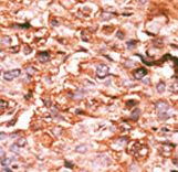 HIST1H3E Antibody - Formalin-fixed and paraffin-embedded human cancer tissue reacted with the primary antibody, which was peroxidase-conjugated to the secondary antibody, followed by AEC staining. This data demonstrates the use of this antibody for immunohistochemistry; clinical relevance has not been evaluated. BC = breast carcinoma; HC = hepatocarcinoma.