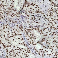 HIST1H3H Antibody - Immunohistochemical analysis of Histone H3 (Di-Methyl K79) staining in human breast cancer formalin fixed paraffin embedded tissue section. The section was pre-treated using heat mediated antigen retrieval with sodium citrate buffer (pH 6.0). The section was then incubated with the antibody at room temperature and detected using an HRP conjugated compact polymer system. DAB was used as the chromogen. The section was then counterstained with hematoxylin and mounted with DPX.