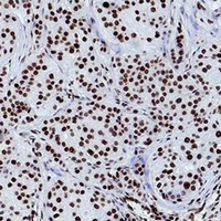 HIST1H3H Antibody - Immunohistochemical analysis of Histone H3 (Tri-Methyl K79) staining in human breast cancer formalin fixed paraffin embedded tissue section. The section was pre-treated using heat mediated antigen retrieval with sodium citrate buffer (pH 6.0). The section was then incubated with the antibody at room temperature and detected using an HRP conjugated compact polymer system. DAB was used as the chromogen. The section was then counterstained with hematoxylin and mounted with DPX.