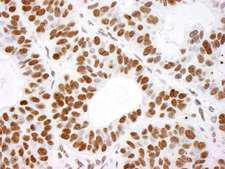 HIST1H4I Antibody - Detection of Human Histone H4 by Immunohistochemistry. Sample: FFPE section of human skin basal cell carcinoma. Antibody: Affinity purified rabbit anti-Histone H4 used at a dilution of 1:200 (1 Detection: DAB.