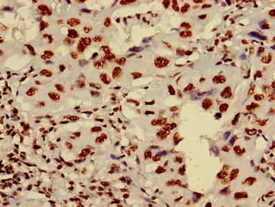 HIST1H4I Antibody - Immunohistochemistry image of paraffin-embedded human lung cancer at a dilution of 1:100