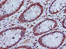 HIST1H4I Antibody - Immunohistochemistry image of paraffin-embedded human colon cancer at a dilution of 1:100
