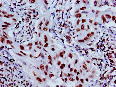 HIST1H4I Antibody - Immunohistochemistry image of paraffin-embedded human lung cancer at a dilution of 1:100