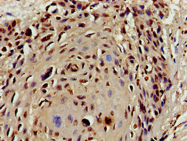 HIST1H4I Antibody - Immunohistochemistry image of paraffin-embedded human cervical cancer at a dilution of 1:100