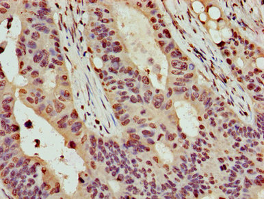HIST1H4I Antibody - Immunohistochemistry image of paraffin-embedded human colon cancer at a dilution of 1:100