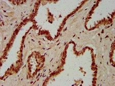 HIST1H4I Antibody - Immunohistochemistry image at a dilution of 1:50 and staining in paraffin-embedded human prostate cancer performed on a Leica BondTM system. After dewaxing and hydration, antigen retrieval was mediated by high pressure in a citrate buffer (pH 6.0) . Section was blocked with 10% normal goat serum 30min at RT. Then primary antibody (1% BSA) was incubated at 4 °C overnight. The primary is detected by a biotinylated secondary antibody and visualized using an HRP conjugated SP system.
