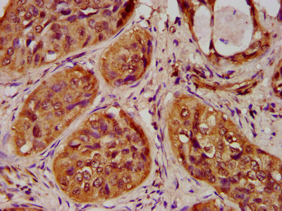HIST1H4I Antibody - Immunohistochemistry image at a dilution of 1:100 and staining in paraffin-embedded human cervical cancer performed on a Leica BondTM system. After dewaxing and hydration, antigen retrieval was mediated by high pressure in a citrate buffer (pH 6.0) . Section was blocked with 10% normal goat serum 30min at RT. Then primary antibody (1% BSA) was incubated at 4 °C overnight. The primary is detected by a biotinylated secondary antibody and visualized using an HRP conjugated SP system.