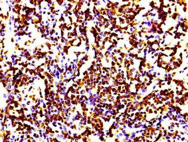 HIST1H4I Antibody - Immunohistochemistry Dilution at 1:100 and staining in paraffin-embedded human lung cancer performed on a Leica BondTM system. After dewaxing and hydration, antigen retrieval was mediated by high pressure in a citrate buffer (pH 6.0). Section was blocked with 10% normal Goat serum 30min at RT. Then primary antibody (1% BSA) was incubated at 4°C overnight. The primary is detected by a biotinylated Secondary antibody and visualized using an HRP conjugated SP system.
